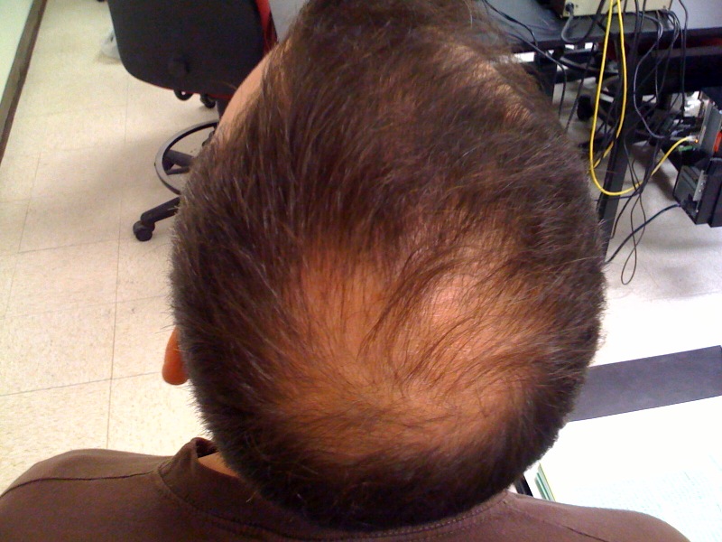 ways to regrow lost hair